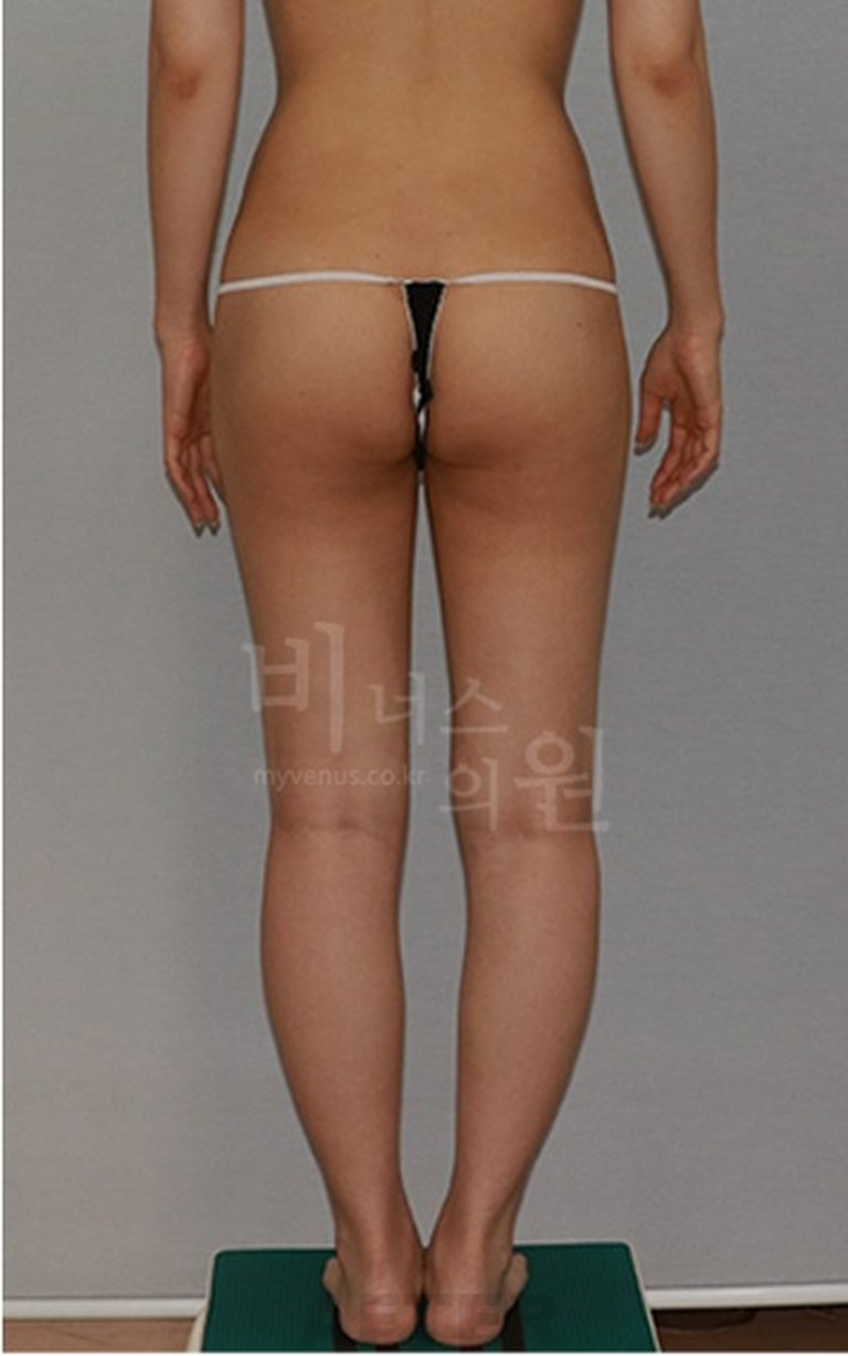 엉덩이축소 수술 후 운동 재개, 헬스장은 언제부터 가능할까요?