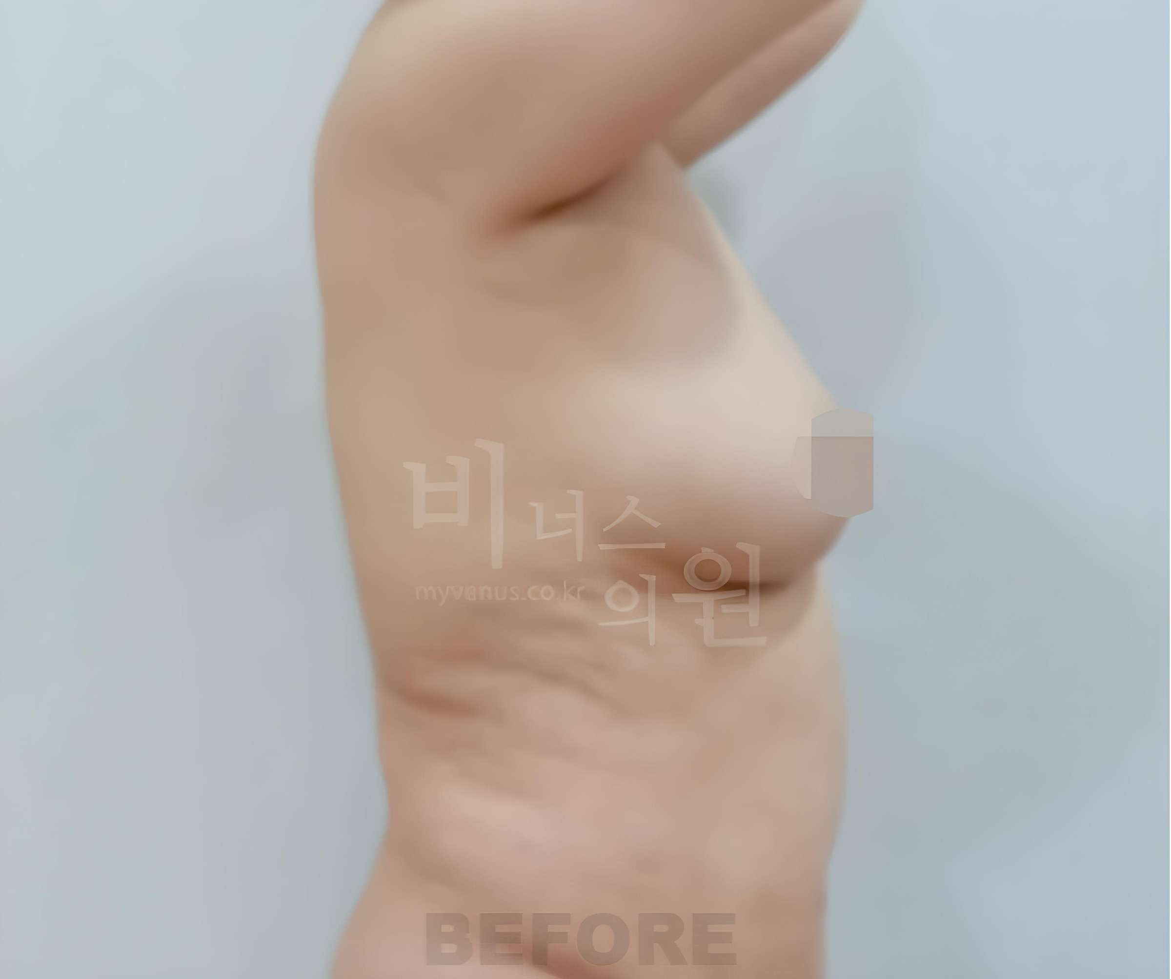 가슴축소 지방흡입 수술 전 측면 사진, 부천 비너스의원