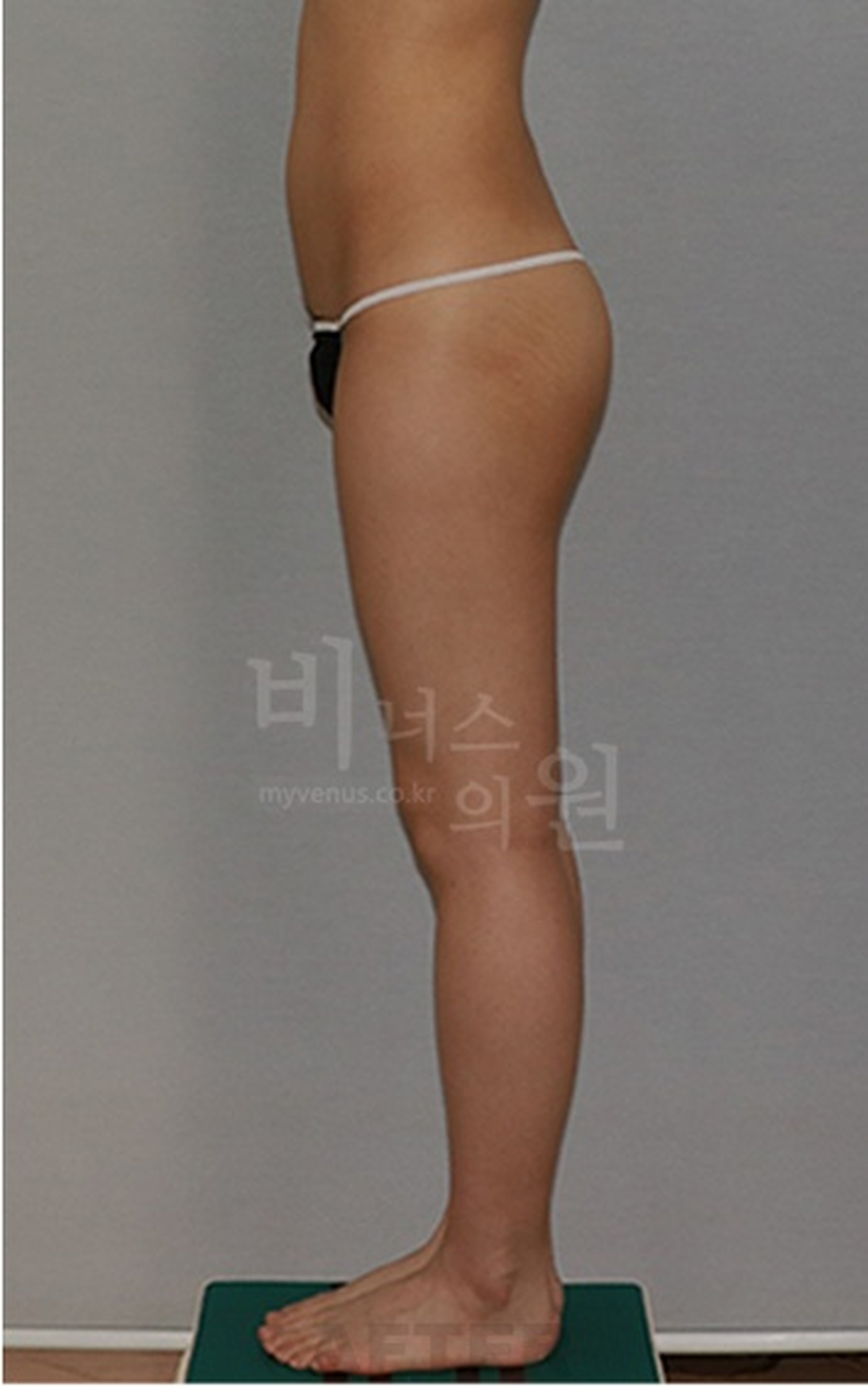 엉덩이축소 지방흡입 수술 후 측면 사진