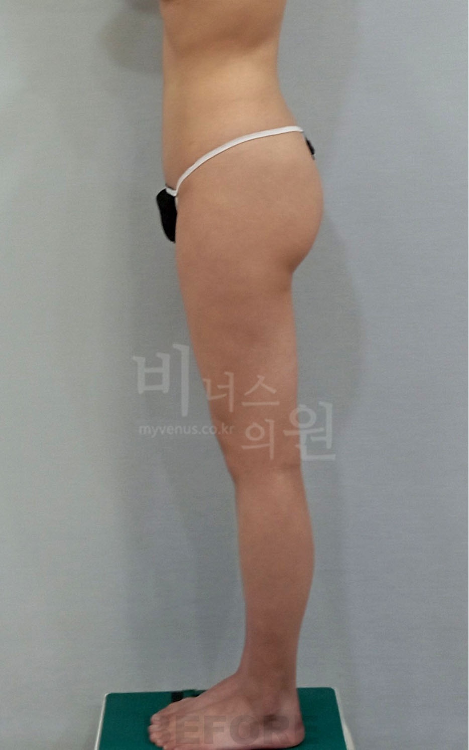 엉덩이축소 지방흡입 수술 전 측면 사진