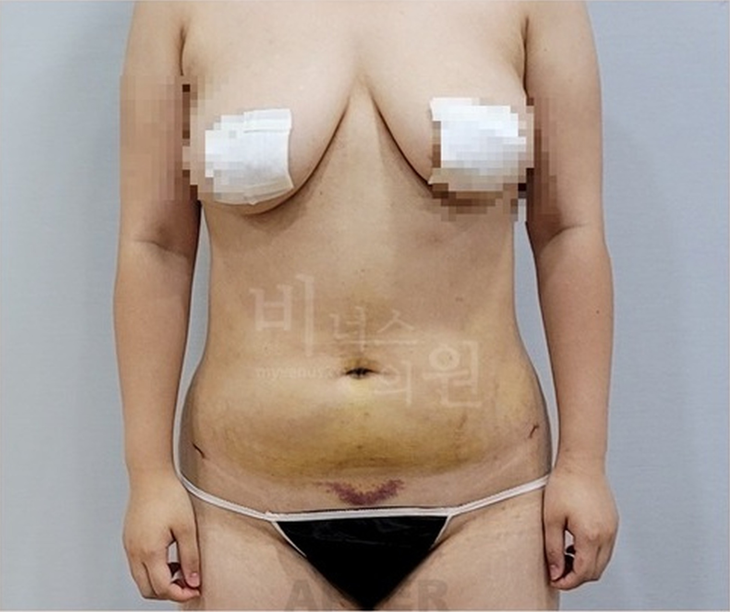 복부 지방흡입 수술 후 1주 경과 정면 사진