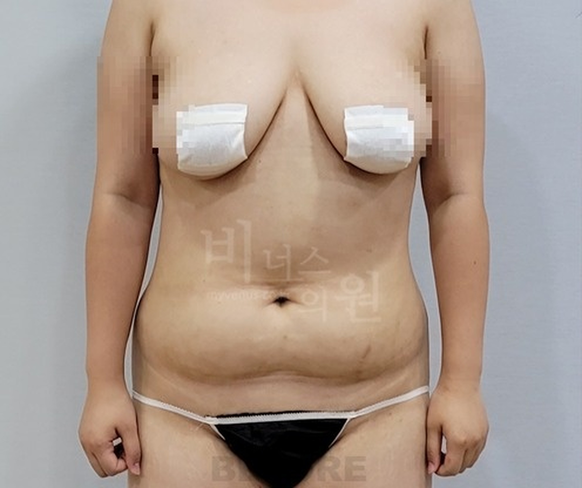 복부 지방흡입 수술 전 정면 사진