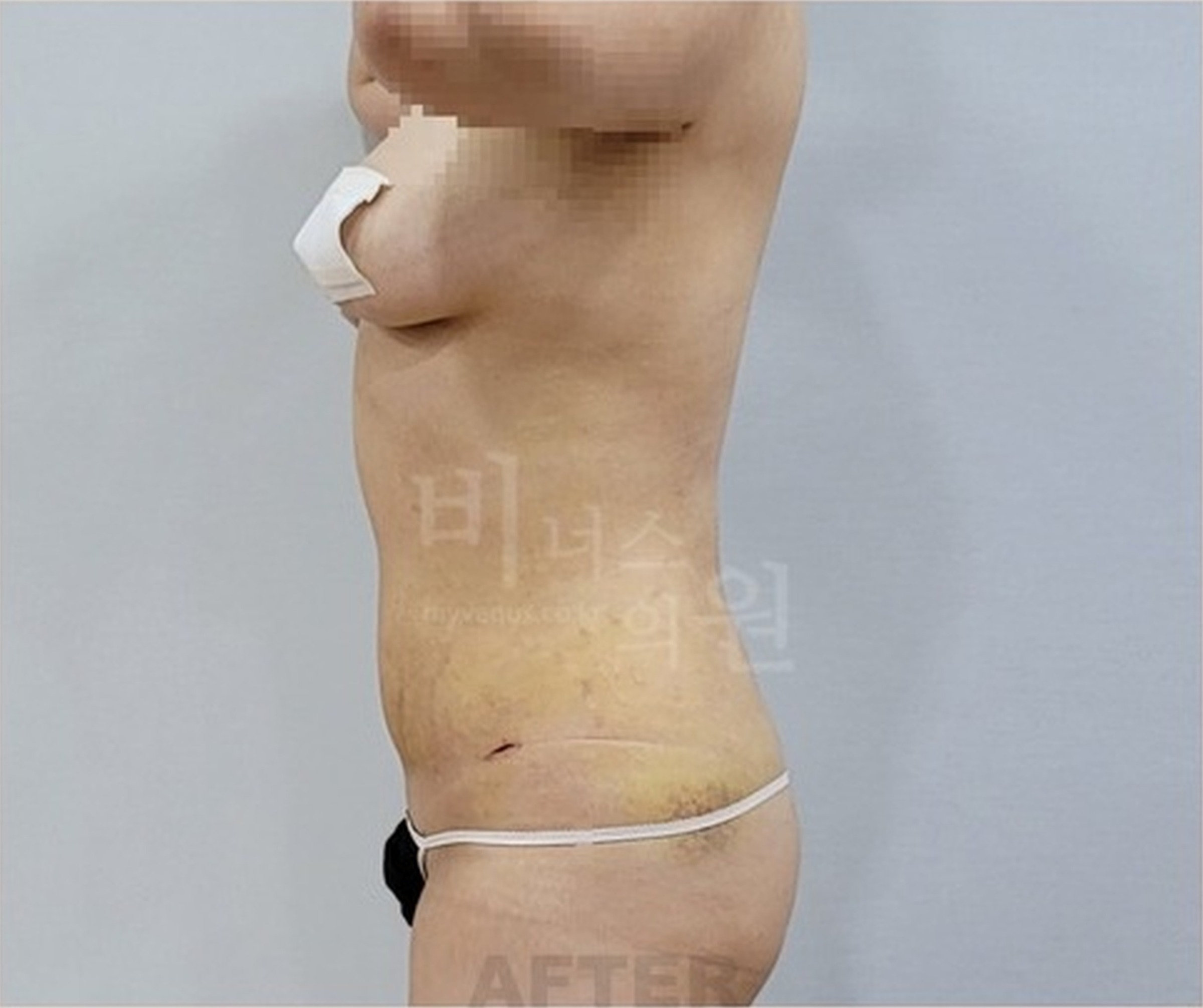 복부 지방흡입 수술 후 1주 경과 우측면 사진