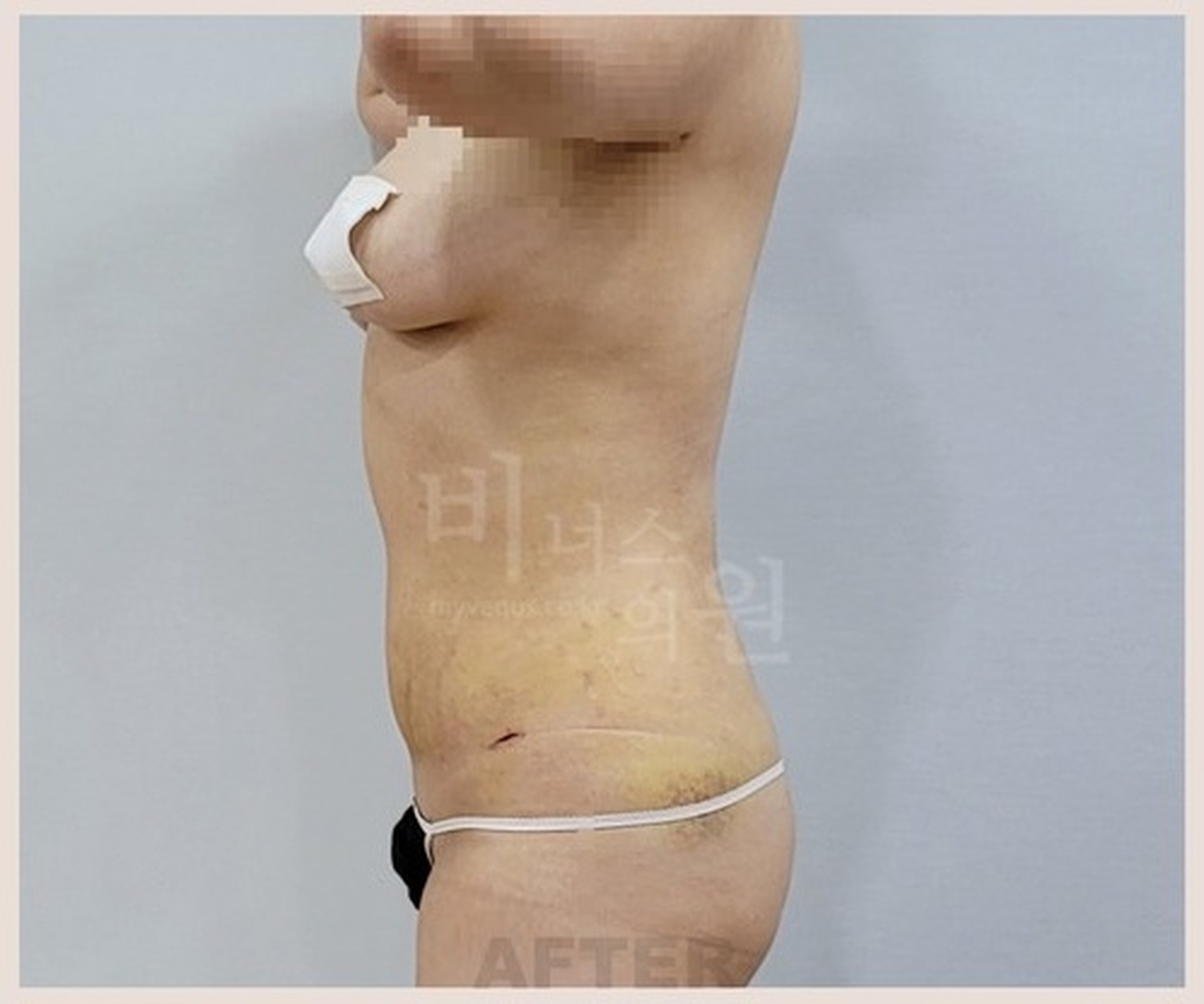 복부 지방흡입 수술 후 1주 경과 우측면 사진