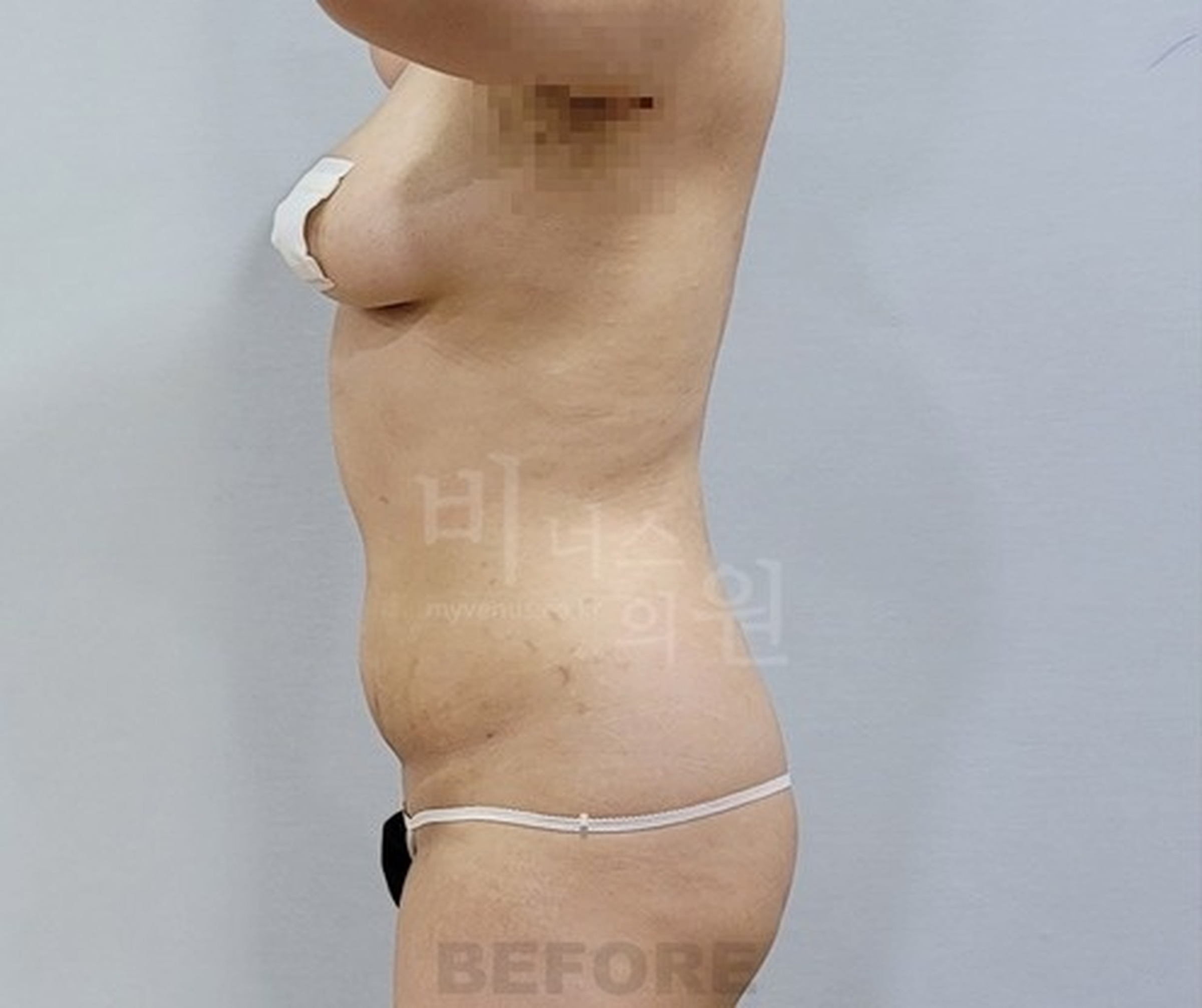 복부 지방흡입 수술 전 우측면 사진