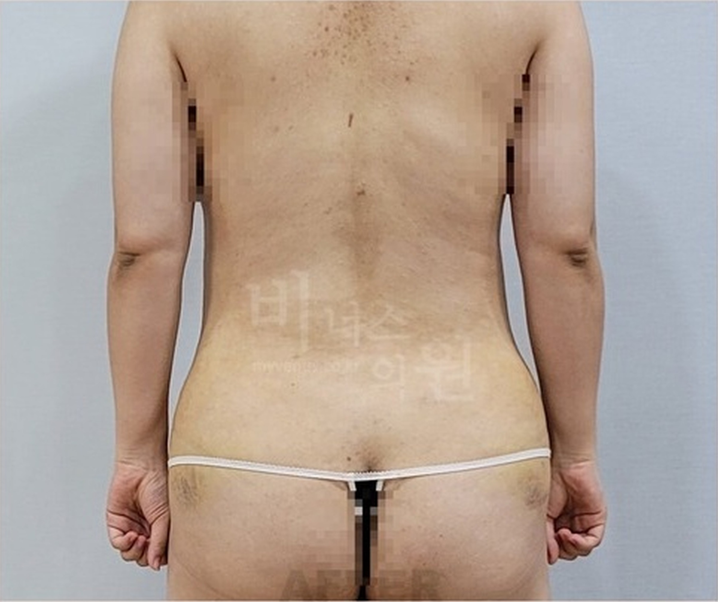복부 지방흡입 수술 후 1주 경과 후면 사진