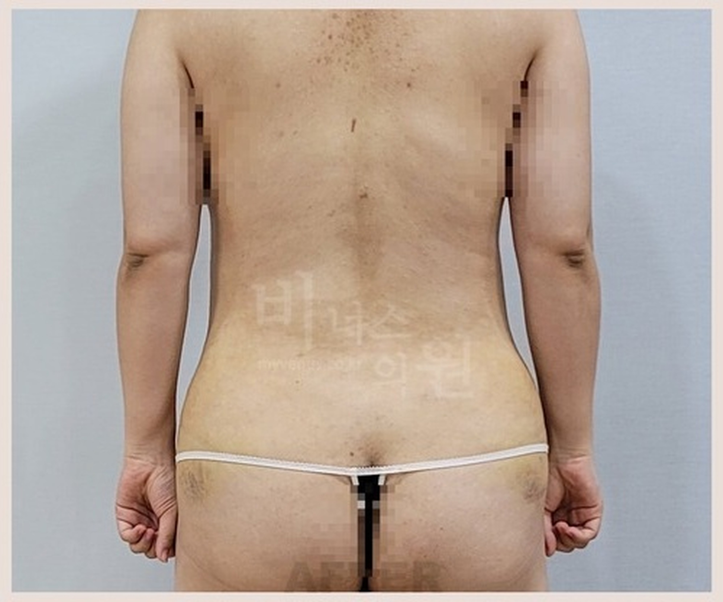 복부 지방흡입 수술 후 1주 경과 후면 사진