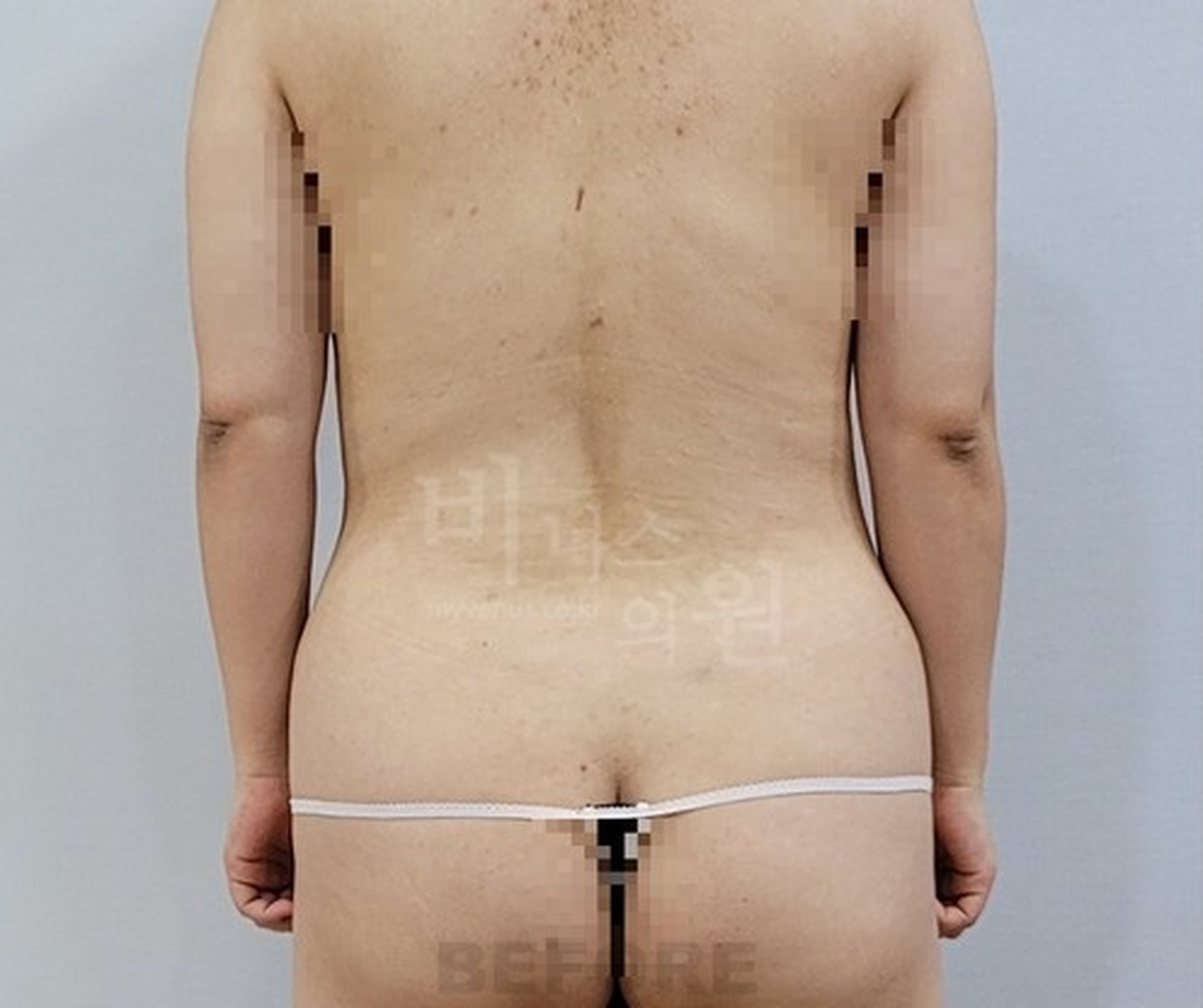 복부 지방흡입 수술 전 후면 사진