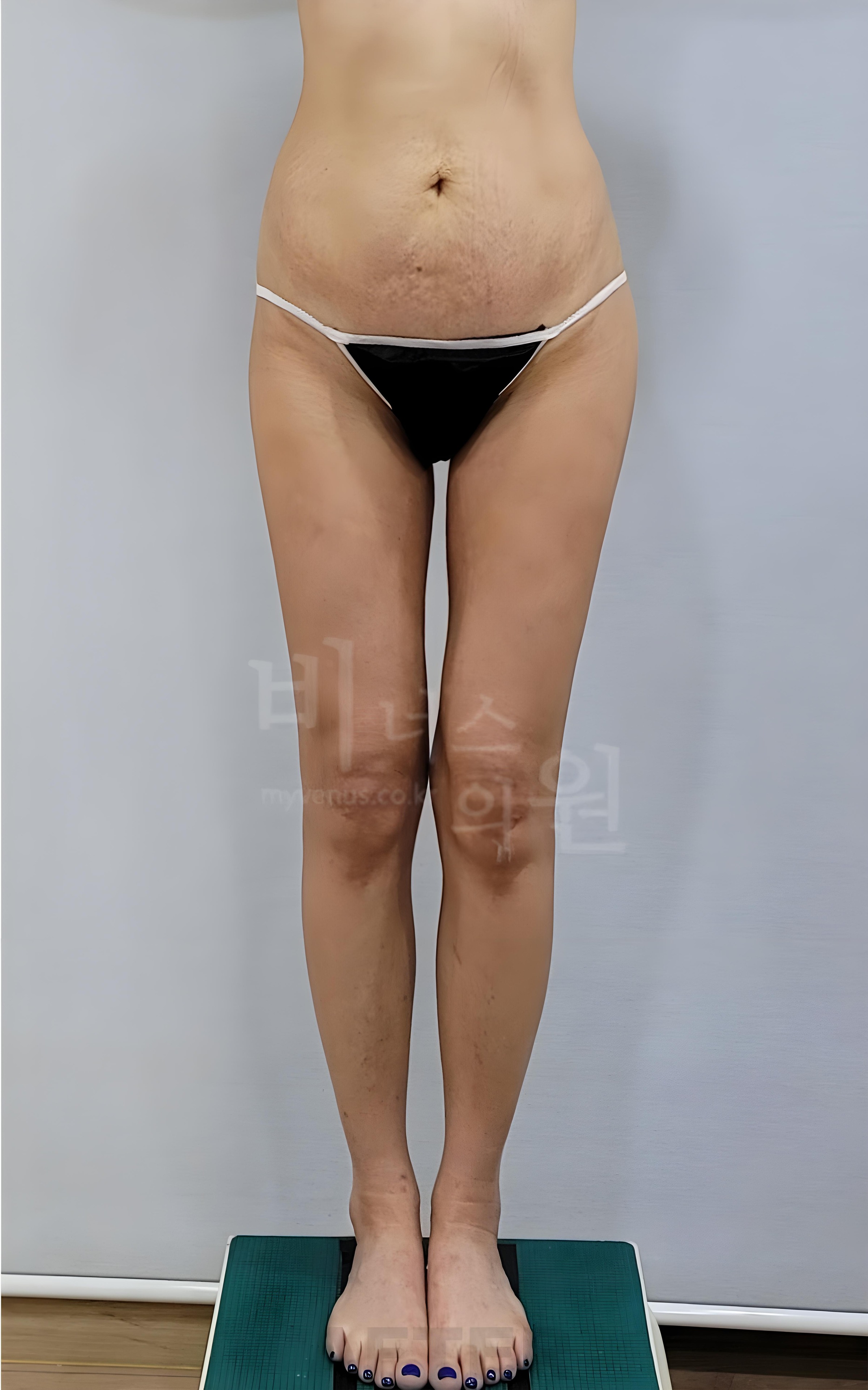 엉덩이축소 지방흡입 수술 후 정면 사진