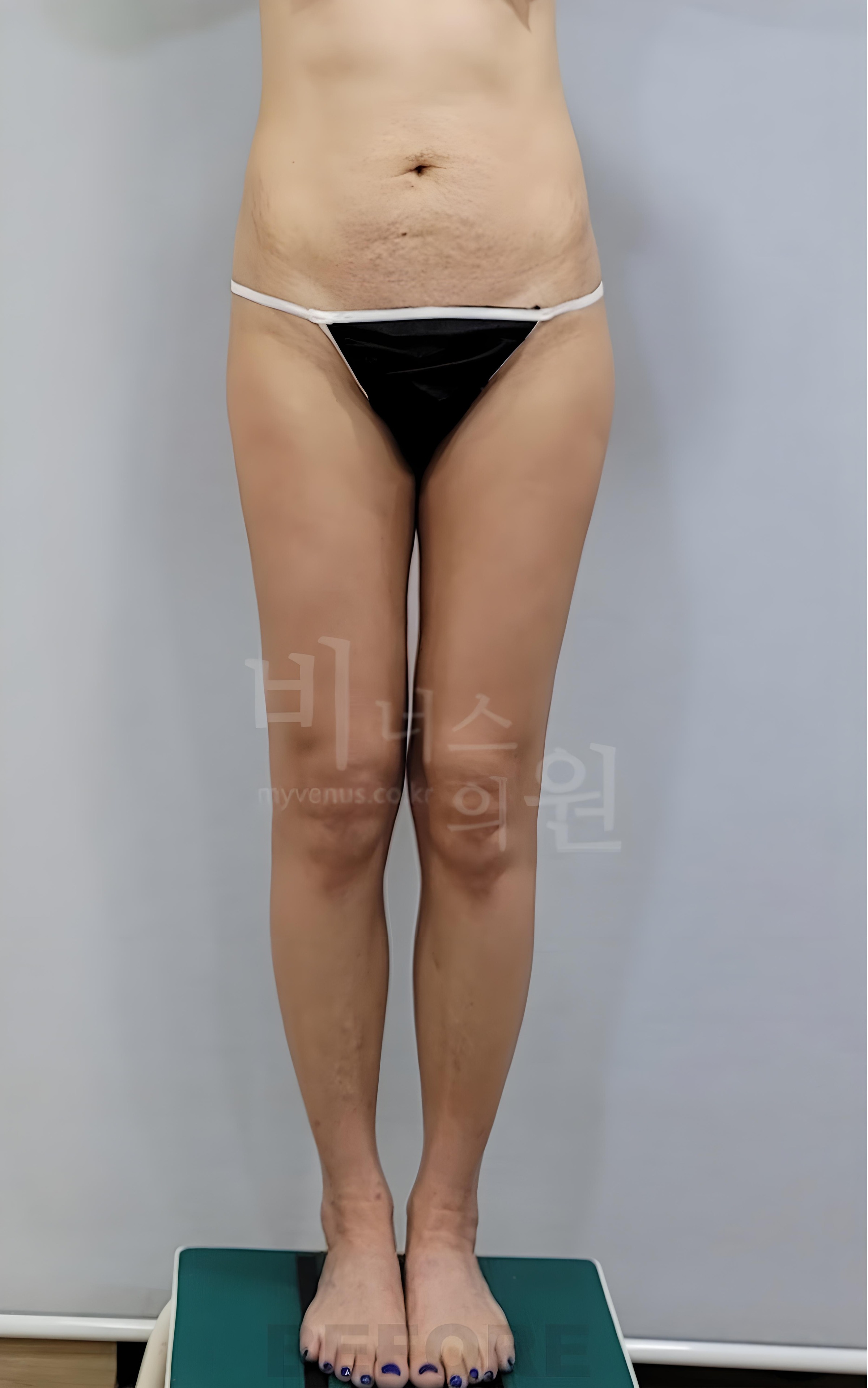 엉덩이축소 지방흡입 수술 전 정면 사진