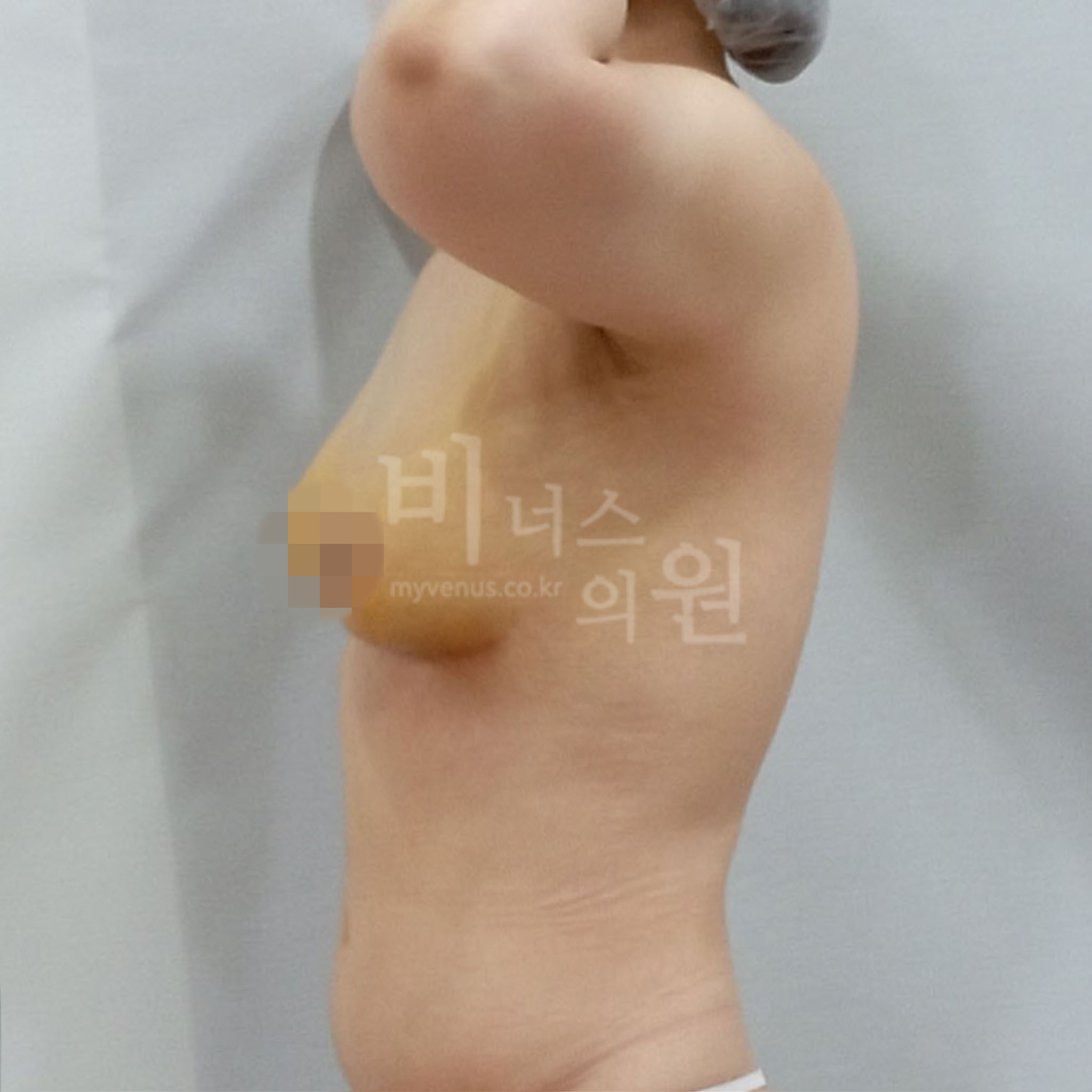 가슴축소 지방흡입 수술 후 측면 사진