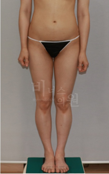 엉덩이축소 지방흡입 수술 후 정면 사진 — 정리된 엉덩이·허벅지 라인