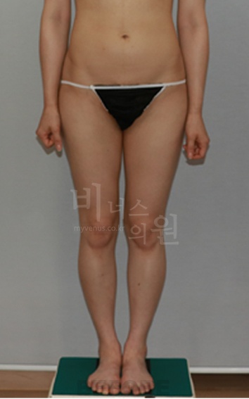 엉덩이축소 지방흡입 수술 전 정면 사진 — 엉덩이·허벅지 라인