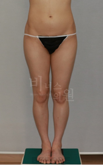 엉덩이축소 지방흡입 수술 전 정면 사진 — 엉덩이 외곽과 힙 라인