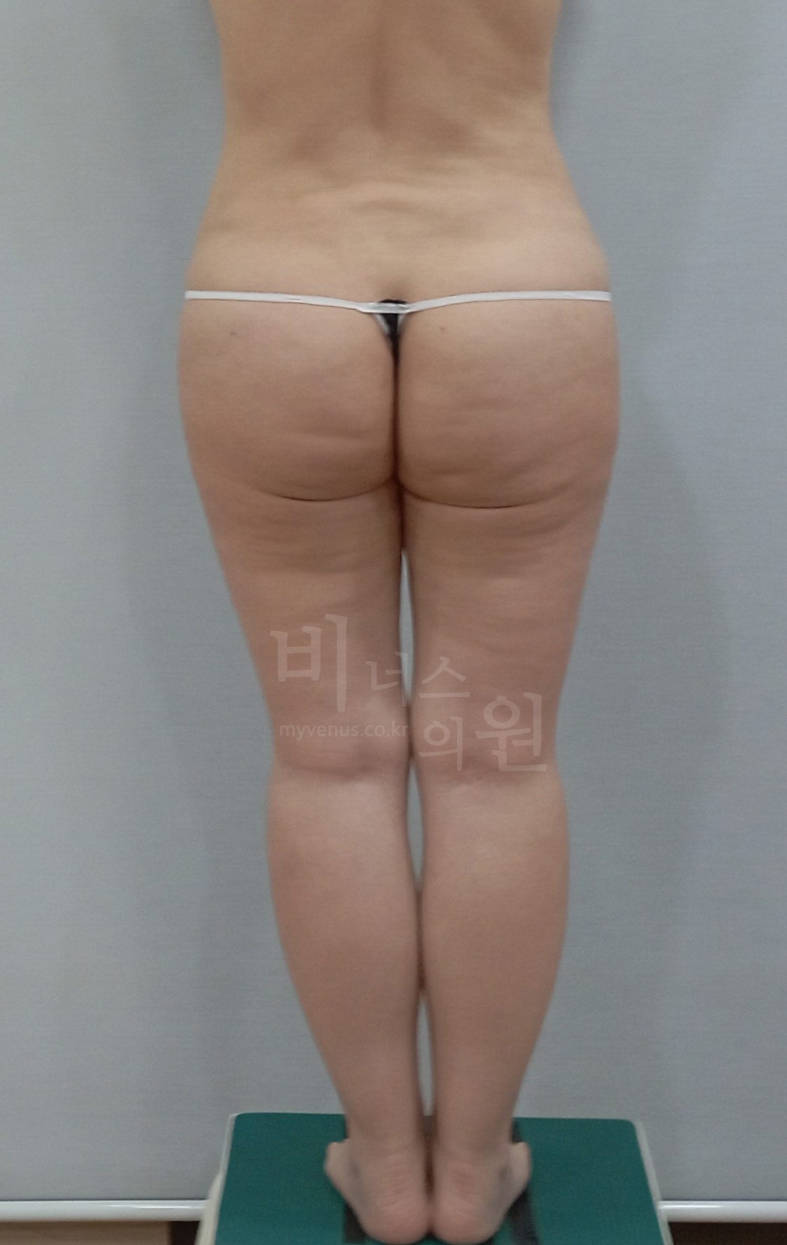 엉덩이축소 지방흡입 수술 전 후면 사진