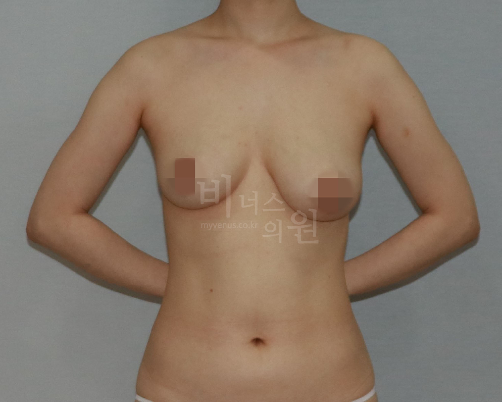 가슴축소 지방흡입 수술 전 정면 사진