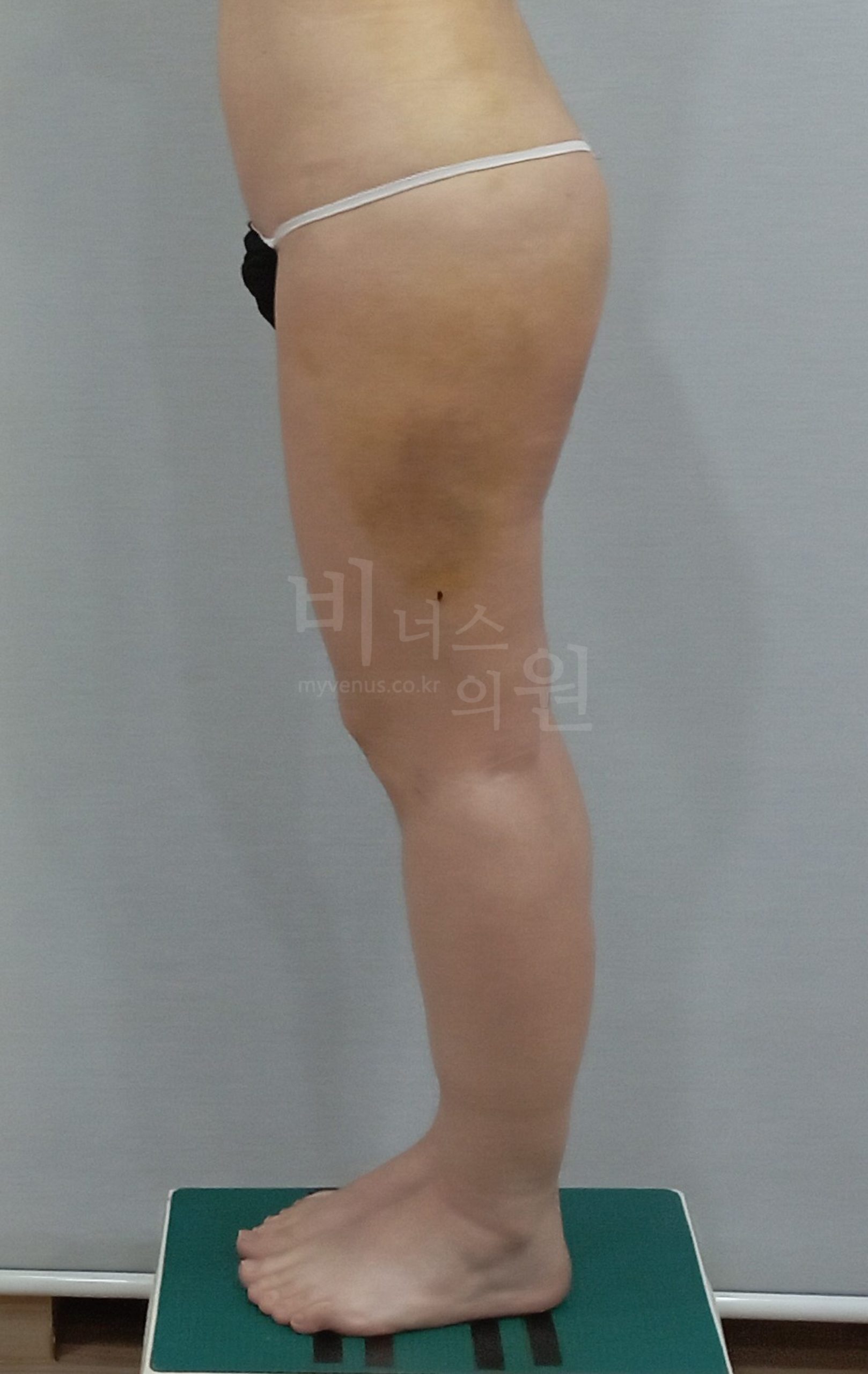 엉덩이축소 지방흡입 수술 후 측면 사진