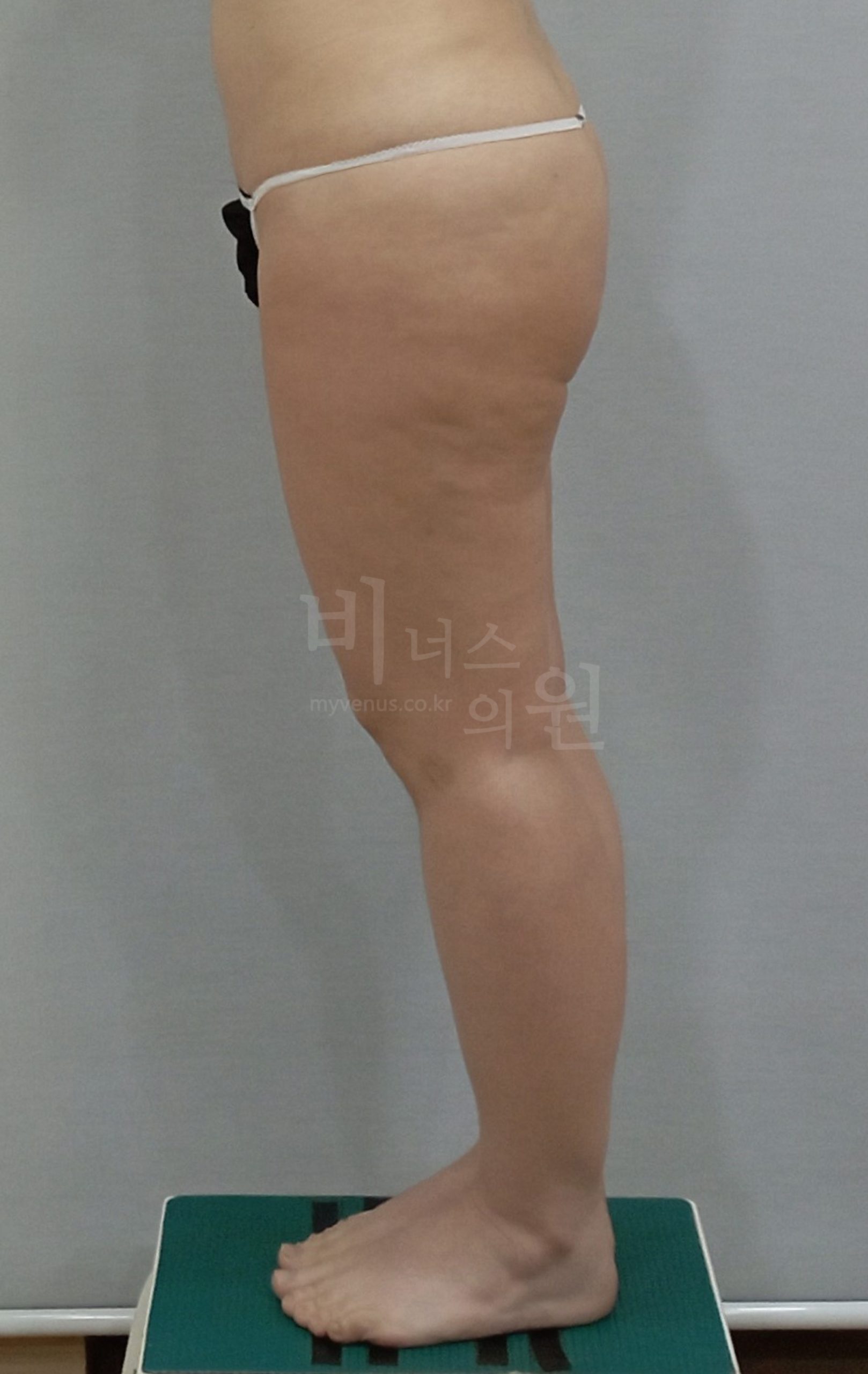 엉덩이축소 지방흡입 수술 전 측면 사진