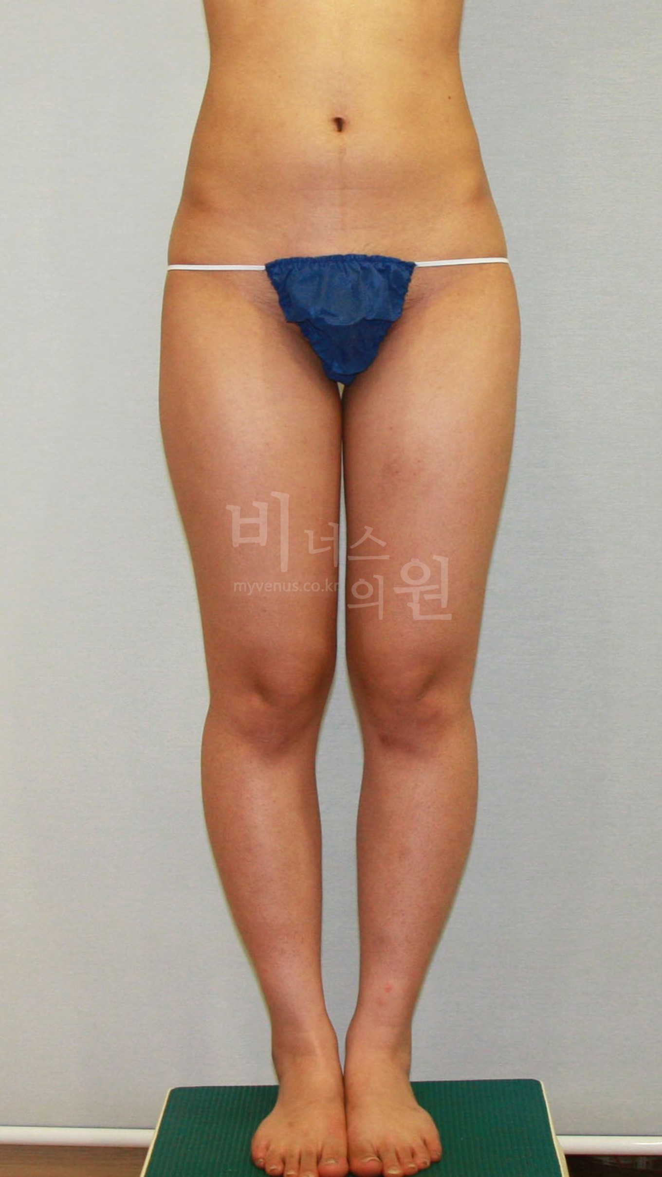 허벅지 지방흡입 수술 전 정면 사진