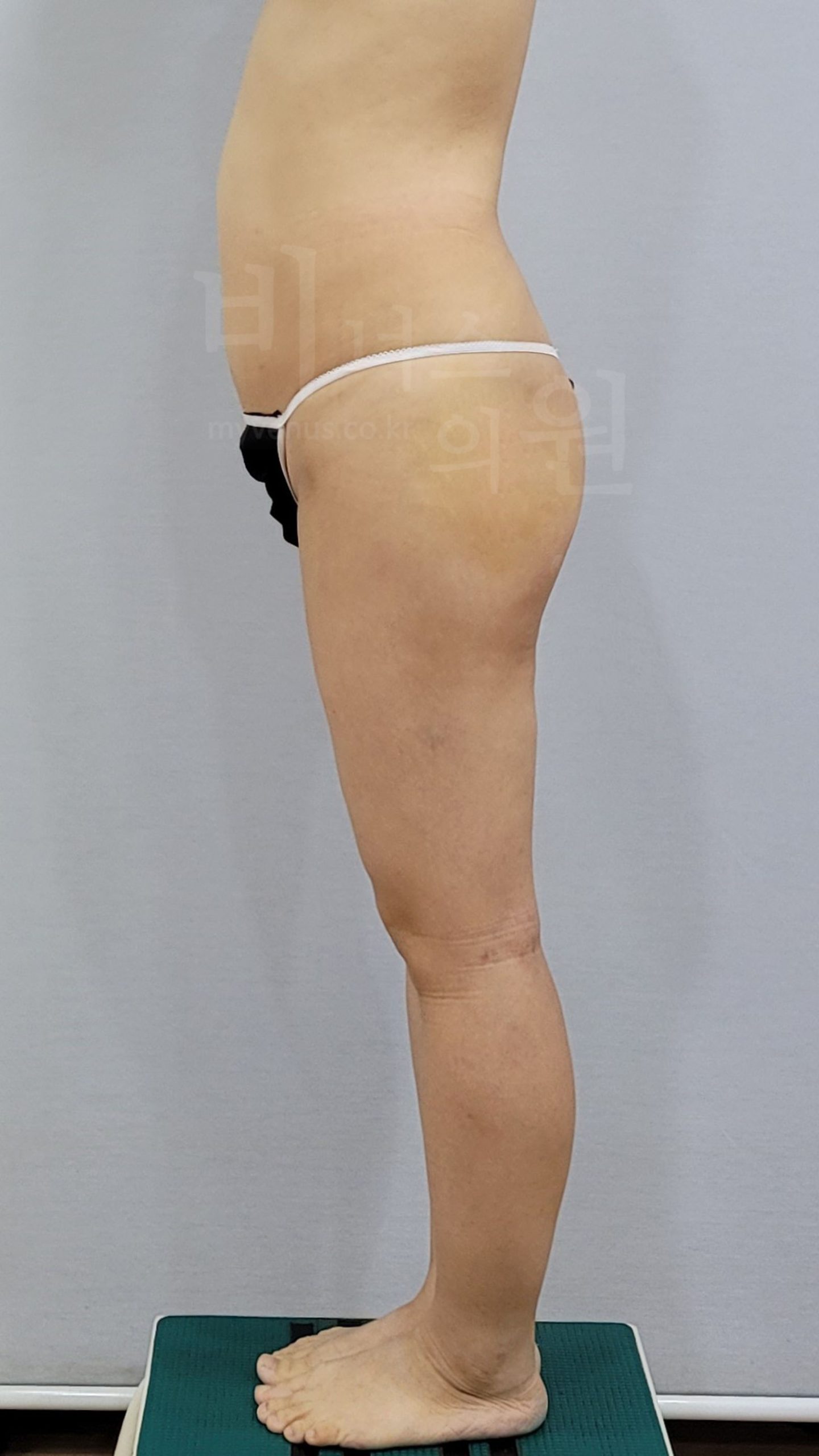 수술 후 측면 사진, 엉덩이와 다리 라인