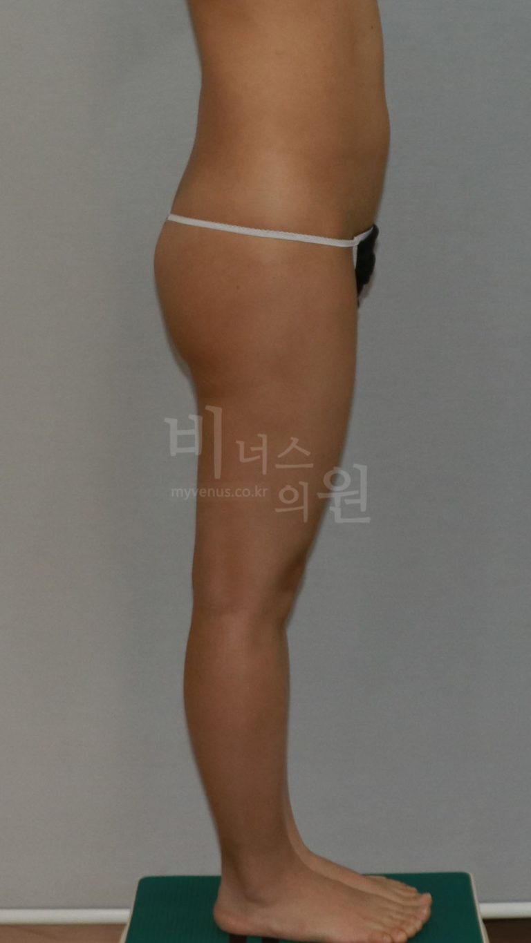 엉덩이처짐 지방흡입, 수술 후 일상 복귀까지 시기별 관리 루틴