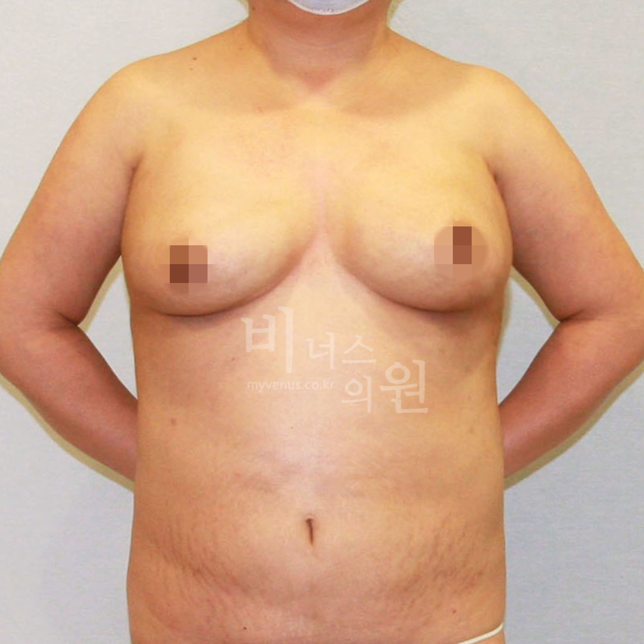 유방하수 표층 지방흡입 수술 후 정면 사진