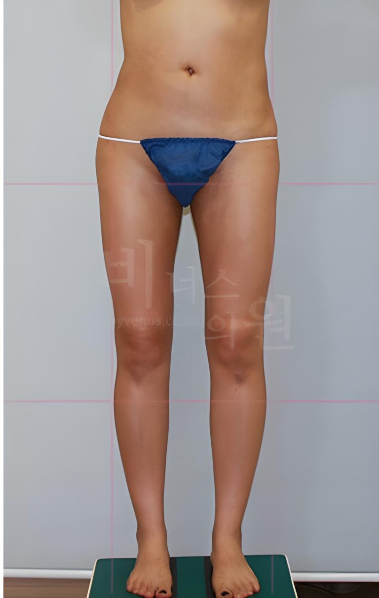 엉덩이처짐, 고민에서 회복까지 — 마음이 움직이는 순서