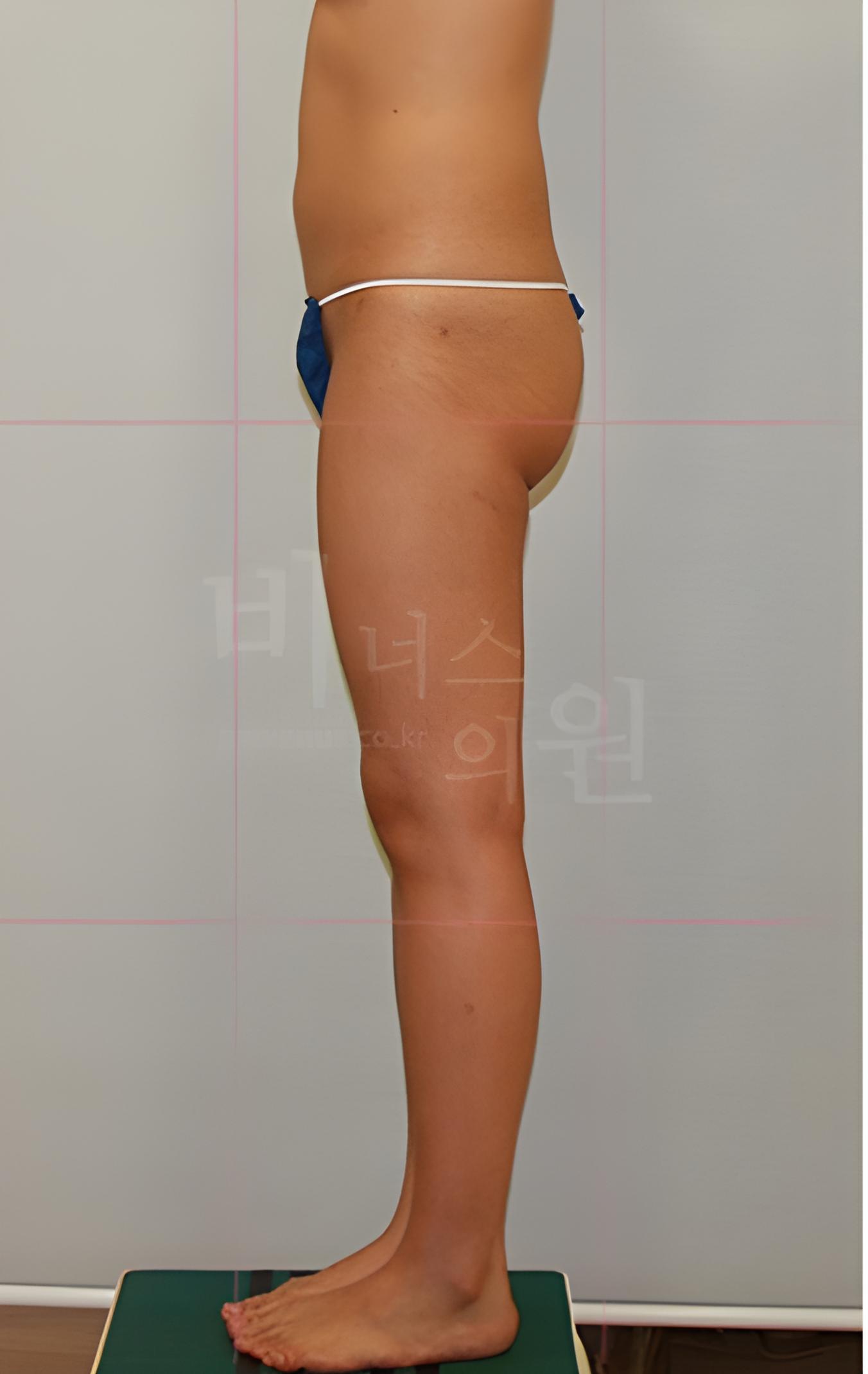 엉덩이처짐 표층 지방흡입 수술 전 측면 사진
