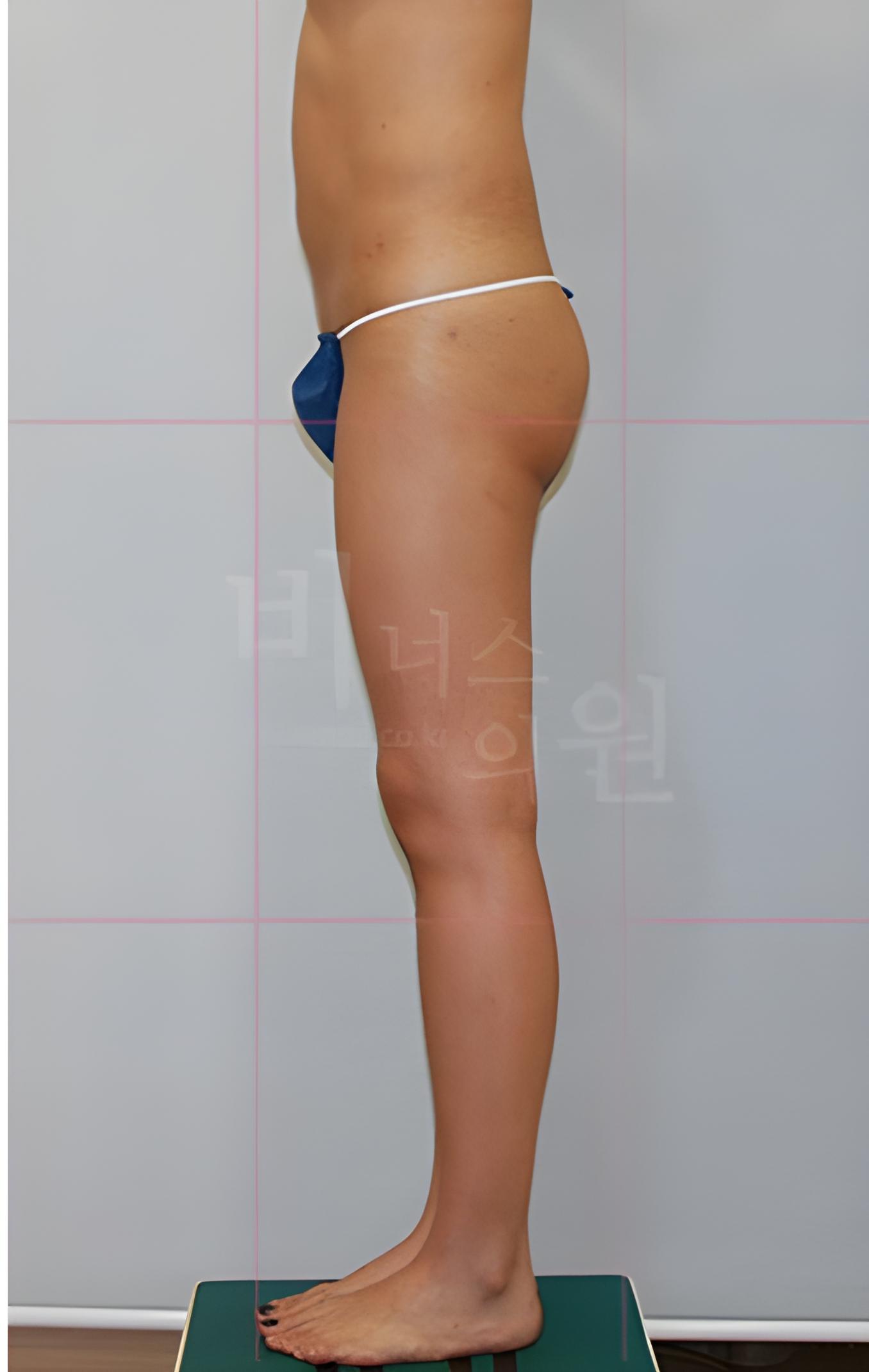 엉덩이처짐 표층 지방흡입 수술 후 측면 사진