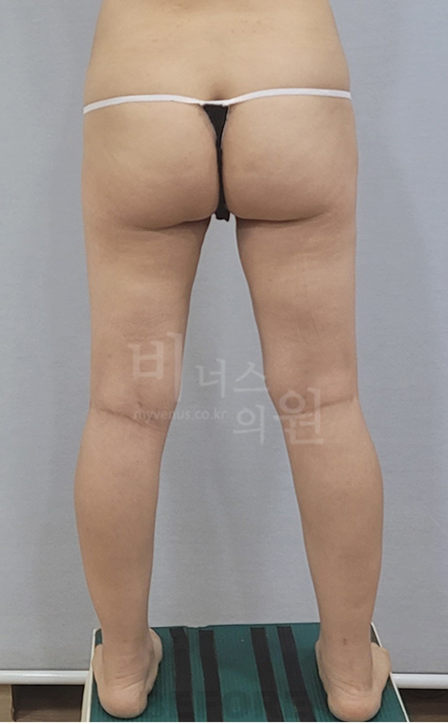 엉덩이축소 지방흡입 수술 전 후면 사진