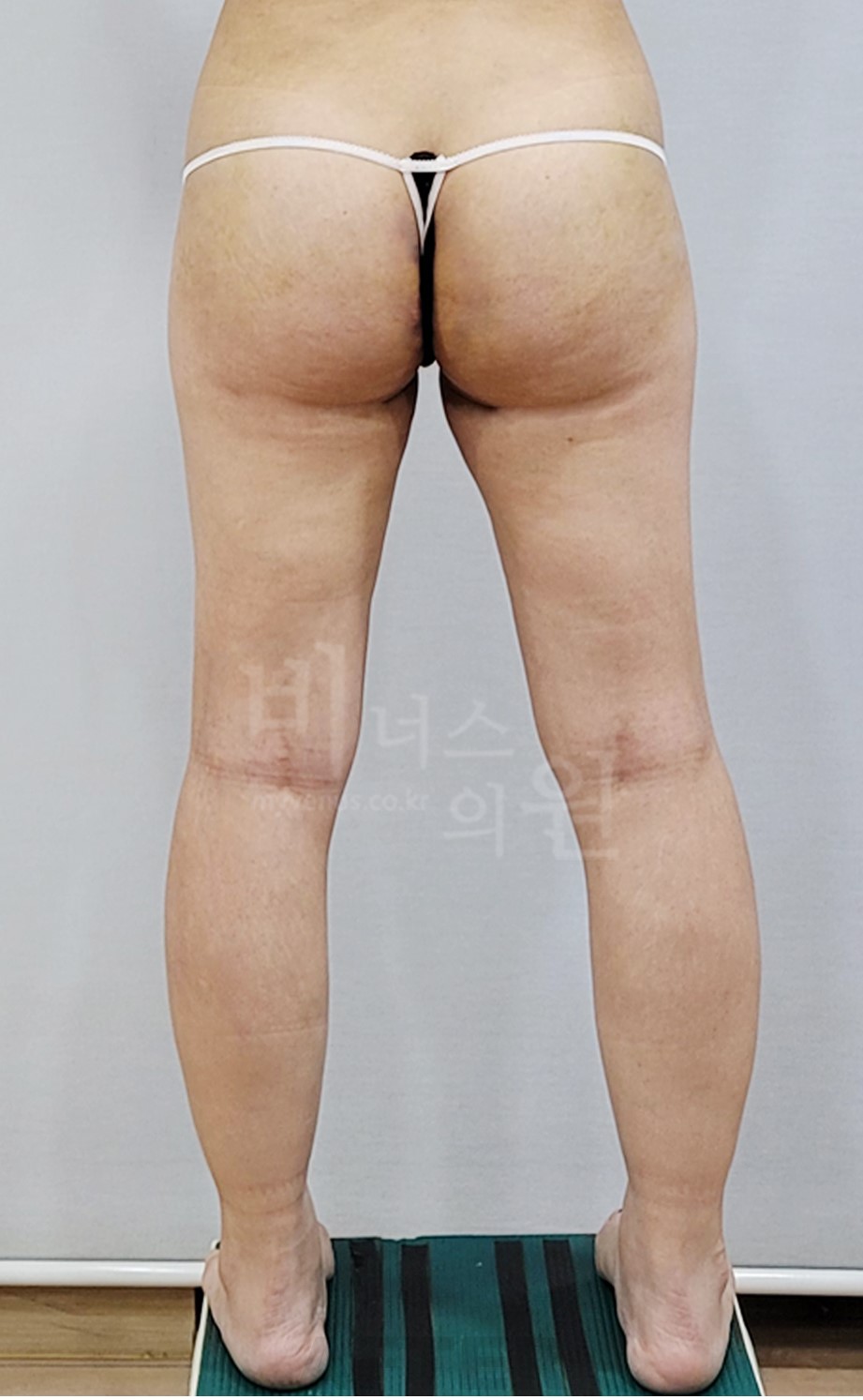 엉덩이축소 지방흡입 수술 후 후면 ② 사진