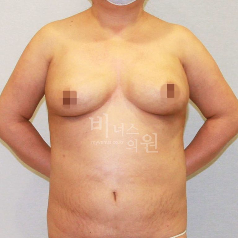 유방하수 표층 지방흡입 후 회복기, 아침·낮·밤으로 나눠 정리했습니다