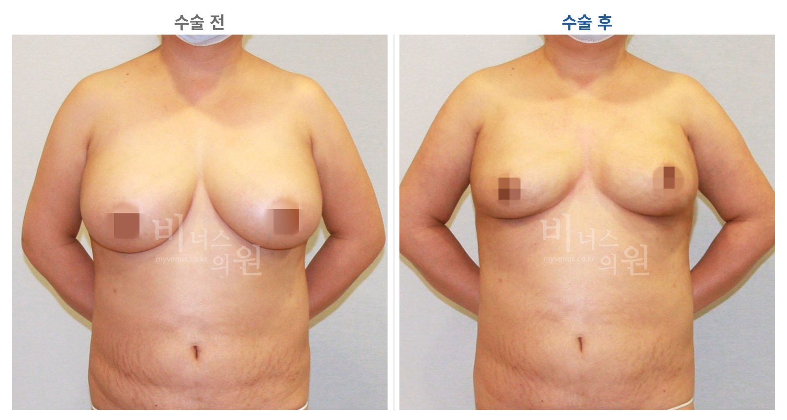 유방하수 가슴축소 표층 지방흡입 수술 전후 정면 비교 사진 비너스의원