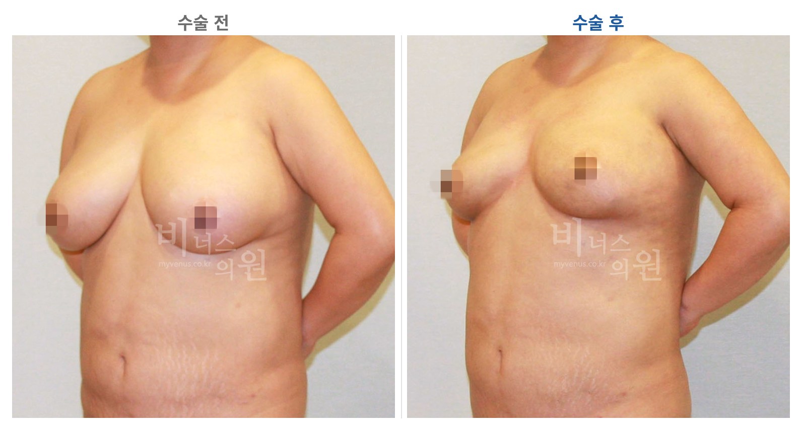 유방하수 가슴축소 표층 지방흡입 수술 전후 45도 측면 비교 사진 비너스의원