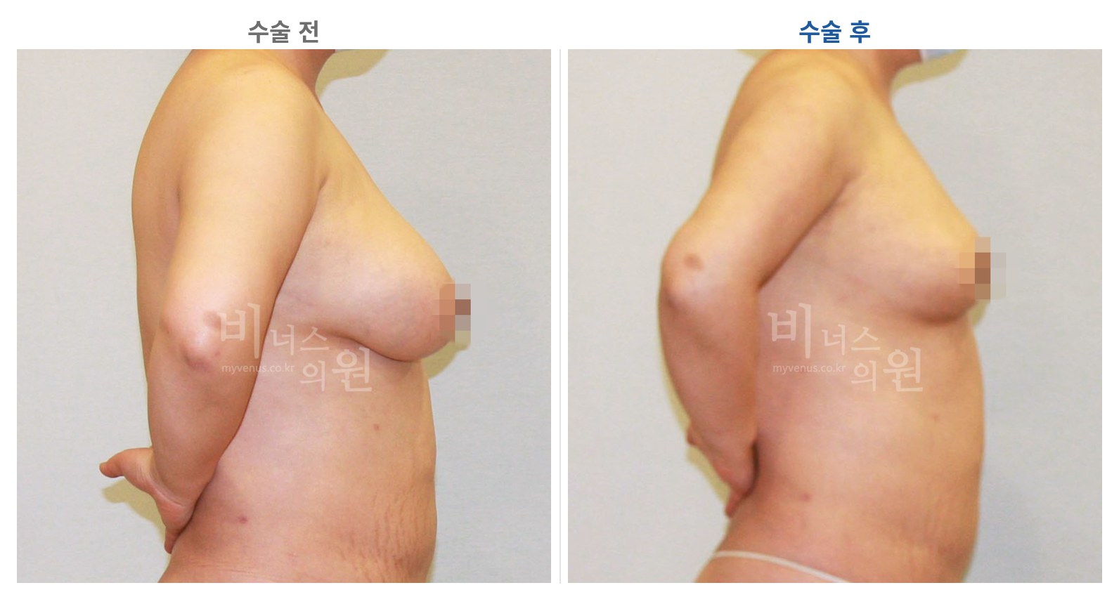 유방하수 가슴축소 표층 지방흡입 수술 전후 측면 비교 사진 비너스의원