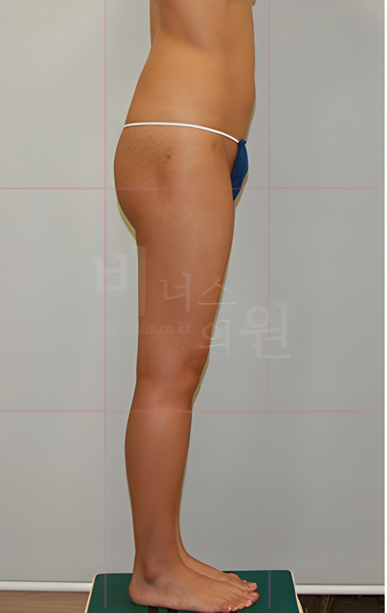 엉덩이 처짐 지방흡입 수술 전 전신 옆태 사진
