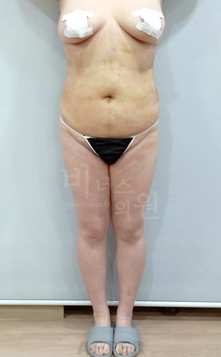 복부·엉덩이 지방흡입 수술 후 정면 사진