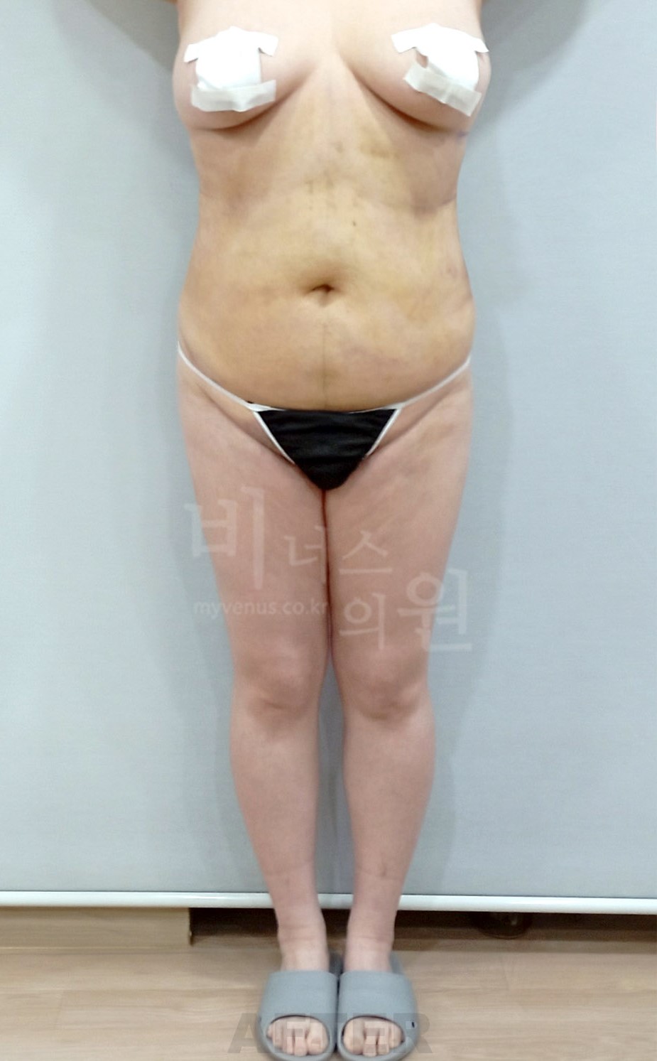 복부·엉덩이 지방흡입 수술 후 정면 사진