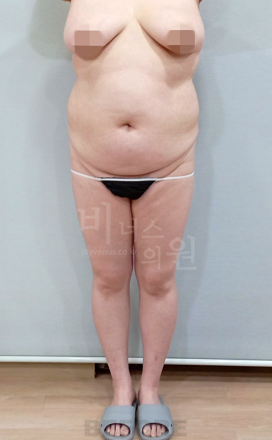 복부·엉덩이 지방흡입 수술 전 정면 사진