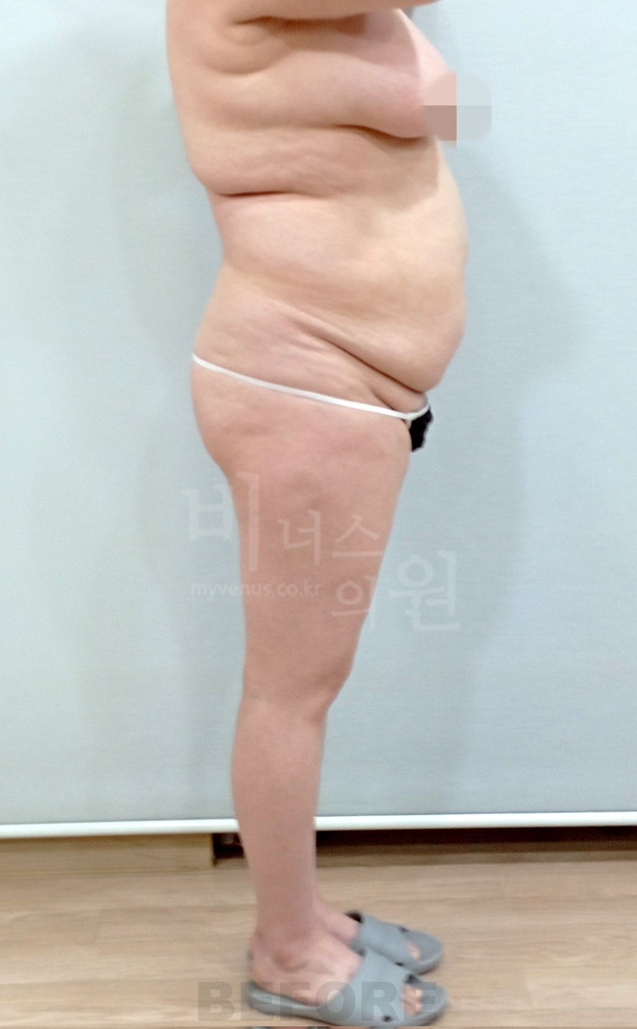 복부·엉덩이 지방흡입 수술 전 좌측면 사진