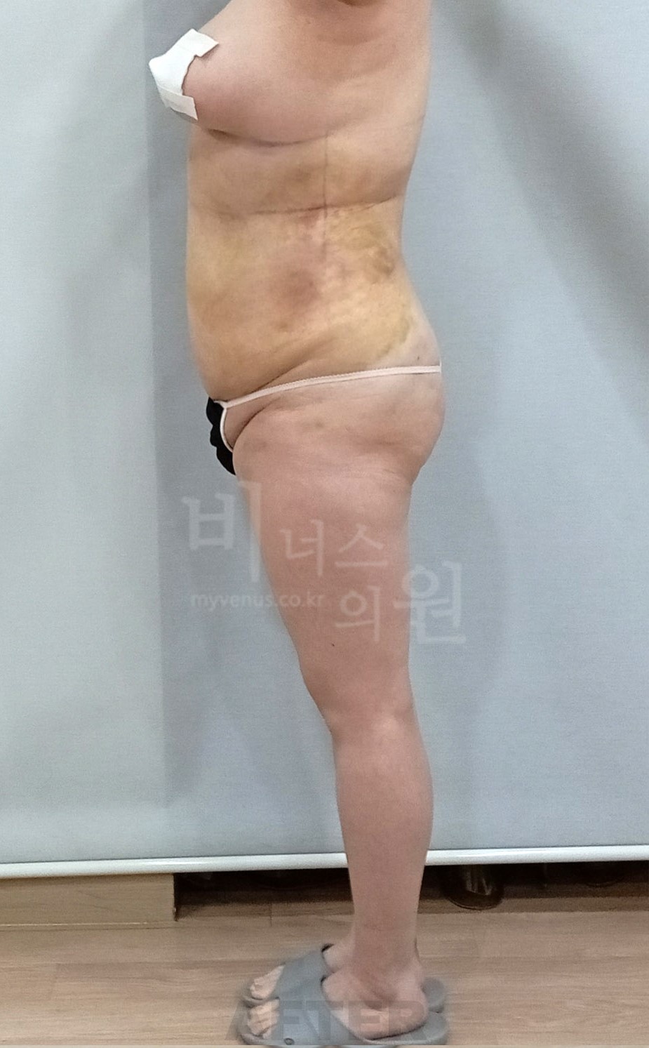 복부·엉덩이 지방흡입 수술 후 우측면 사진