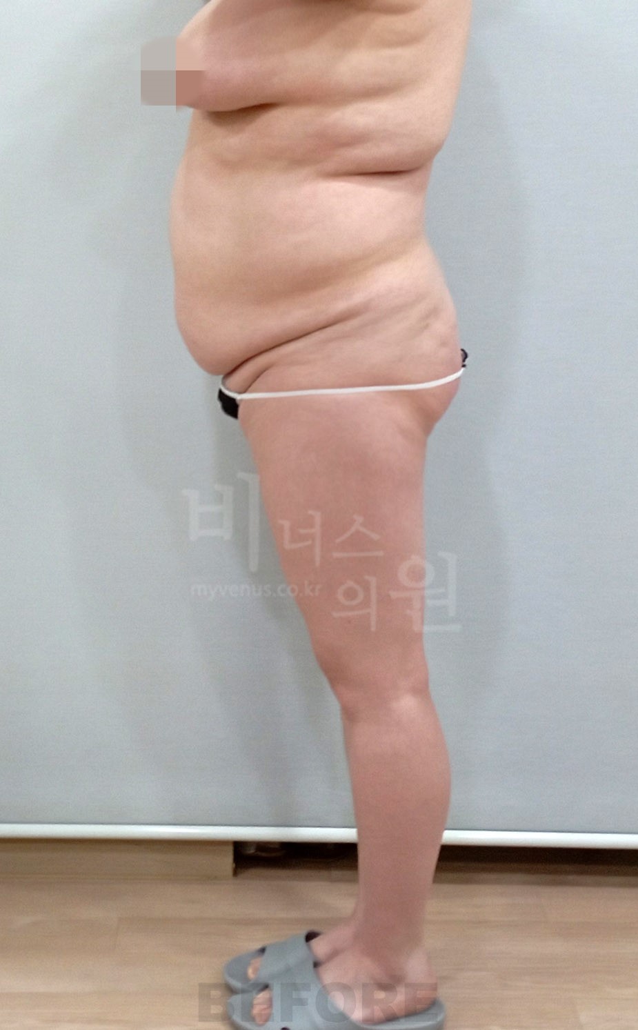복부·엉덩이 지방흡입 수술 전 우측면 사진