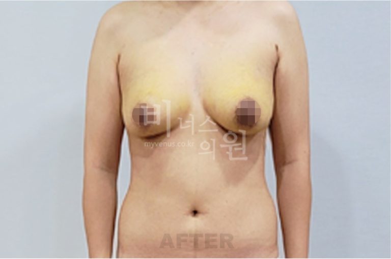 유방하수 지방흡입 수술 후 정면 (팔 내림)