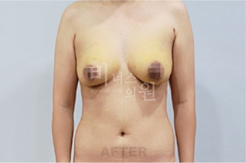 유방하수 지방흡입 수술 후 정면 (팔 내림)