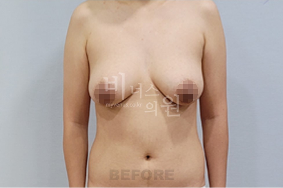 유방하수 지방흡입 수술 전 정면 (팔 내림)