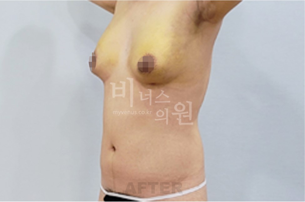 유방하수 지방흡입 수술 후 45도 측면 1 (팔 올림)