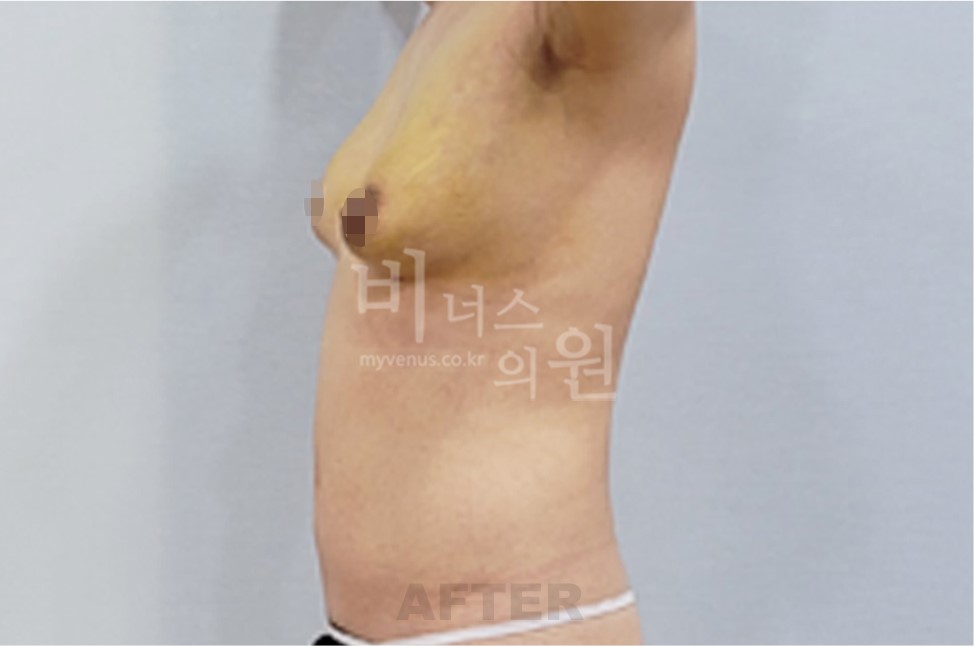 유방하수 지방흡입 수술 후 측면 1 (팔 올림)