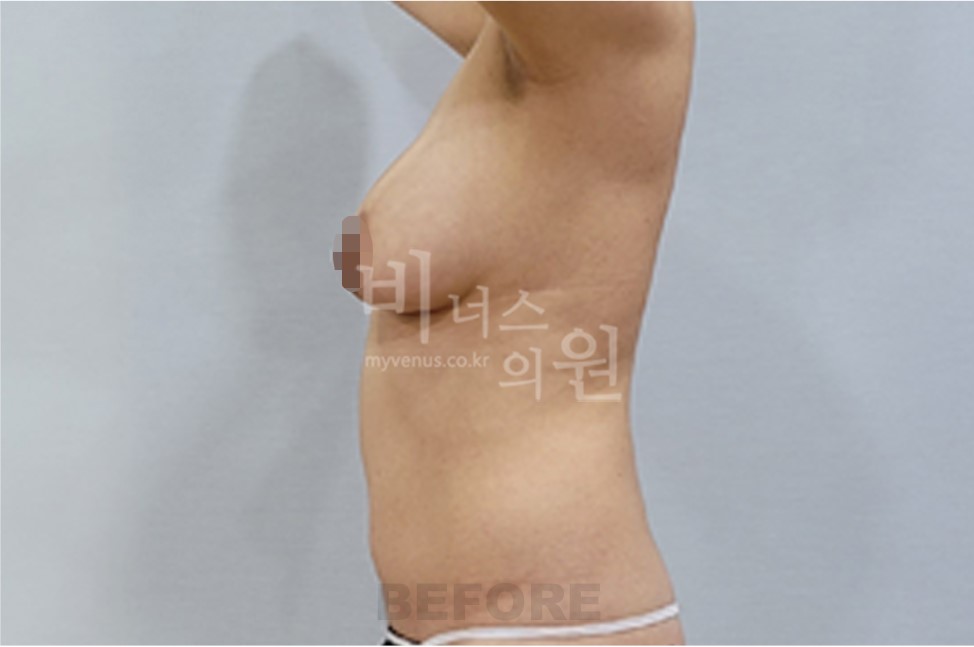 유방하수 지방흡입 수술 전 측면 1 (팔 올림)