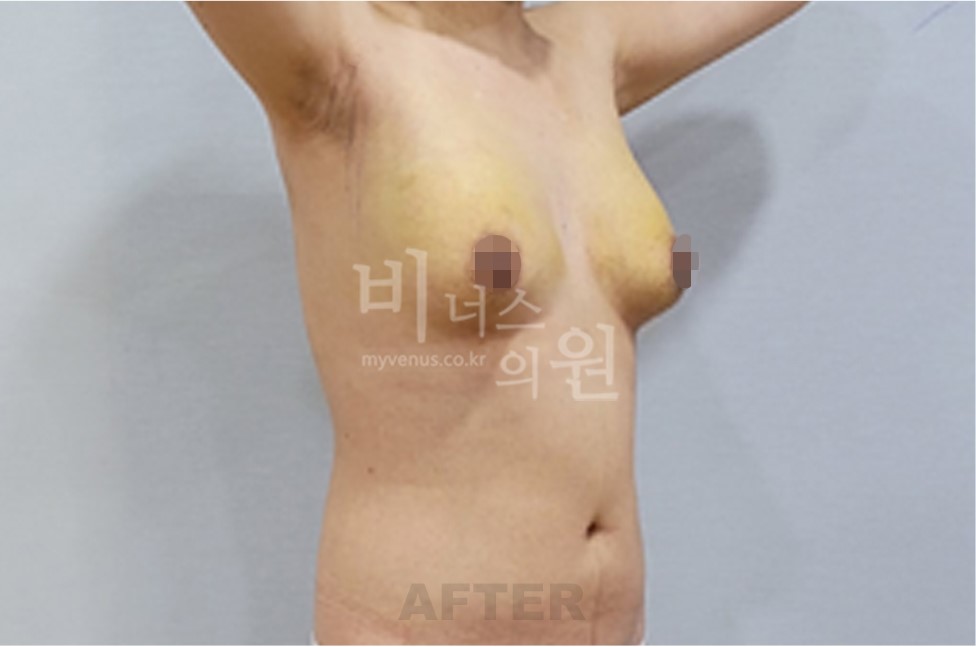 유방하수 지방흡입 수술 후 45도 측면 2 (팔 올림)