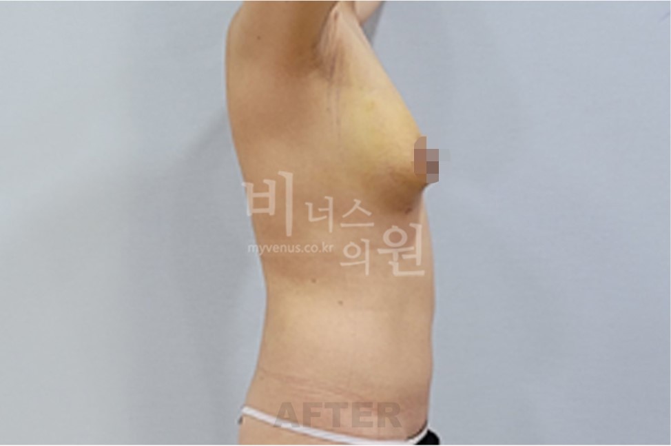 유방하수 지방흡입 수술 후 측면 2 (팔 올림)